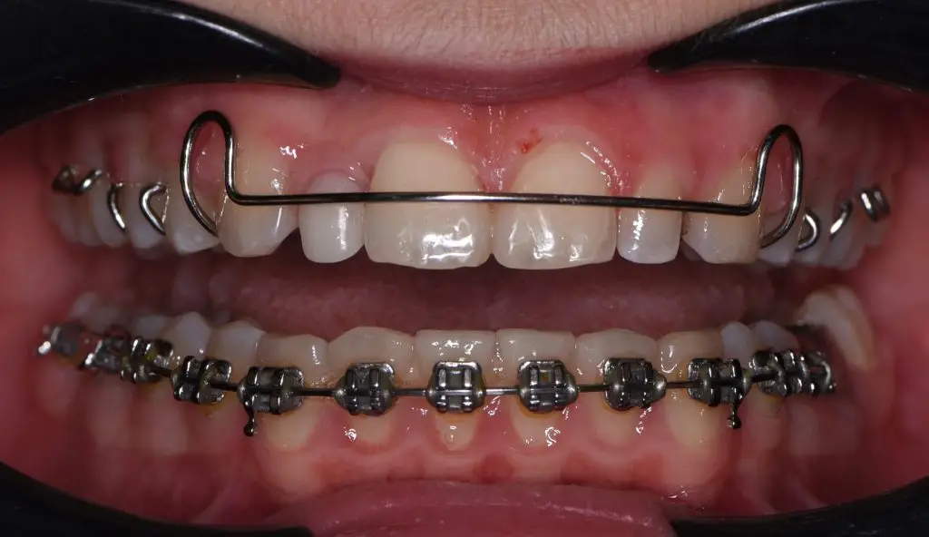 פלטה הולי לשמירת מצב, Hawley Retainer